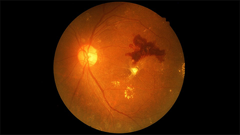 Proteomics reveals protein shifts in diabetic eye disease
