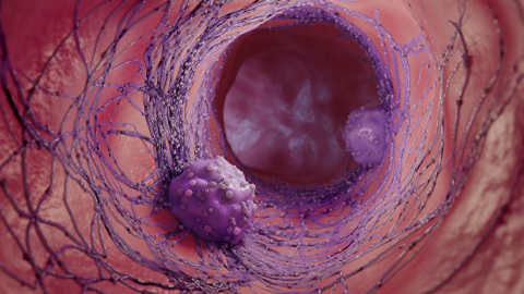 An illustration of cancer cells. This study examined a breast cancer cell line to assess proteins involved in cell migration.