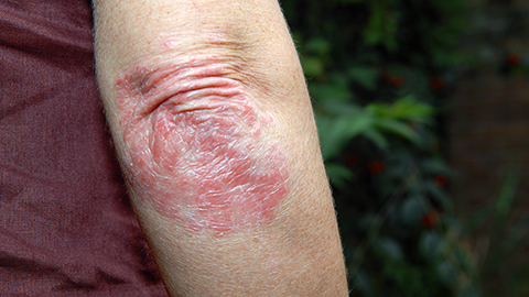 Itching for answers about the role of lipids in psoriasis
