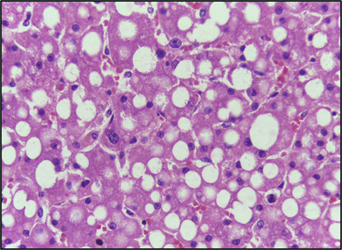 Light microscopy image of liver cells that contain clear vacuoles of fat, depicting liver steatosis.