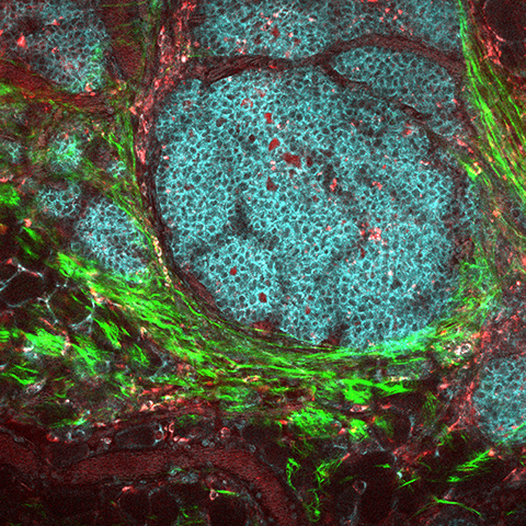 Multiphoton microscopy image of a breast cancer tumor and its microenvironment in a live mouse model.