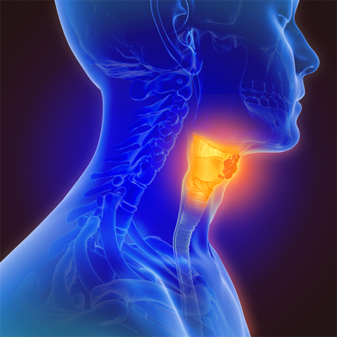 3d illustration of throat cancer.