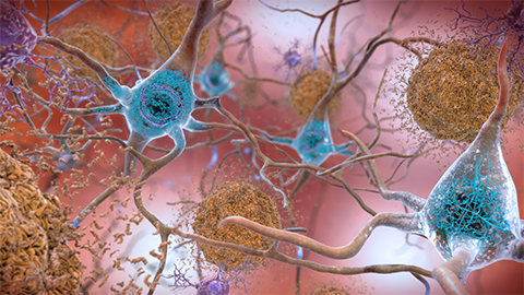 In Alzheimer’s disease, increased levels of the β-amyloid protein clump together to form plaques (seen in brown) that collect between neurons and disrupt cell function.