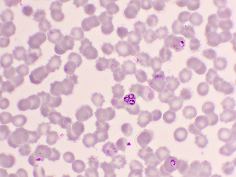 Red blood cells infected with the malaria parasite Plasmodium falciparum in its ring form stage.