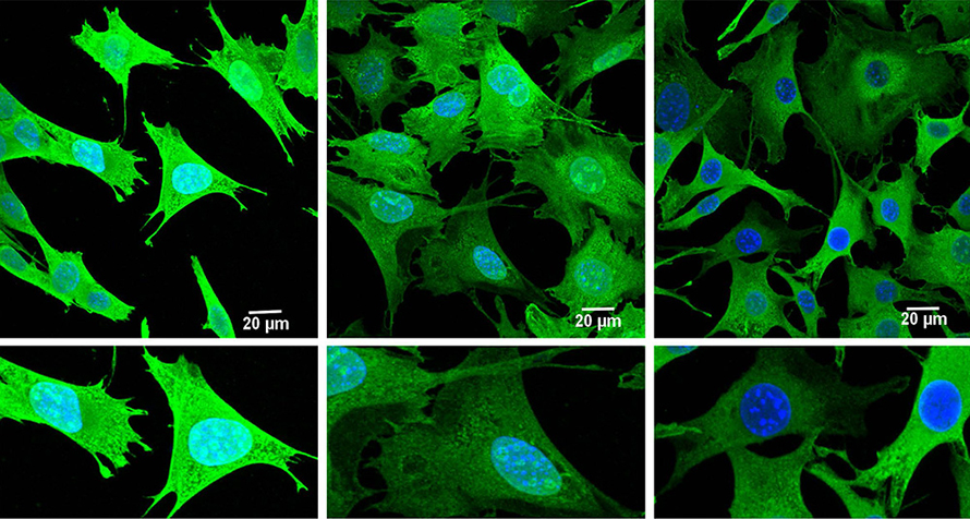 Mitochondrial protein synthesis is diminished in Huntington’s disease cells. These mouse striatal cells have a normal genotype (left) or are heterozygous (center) or homozygous (right) for a Huntington’s disease mutation. Puromycin uptake is shown in green and represents the cellular protein translation rate. Nuclei are shown in blue.