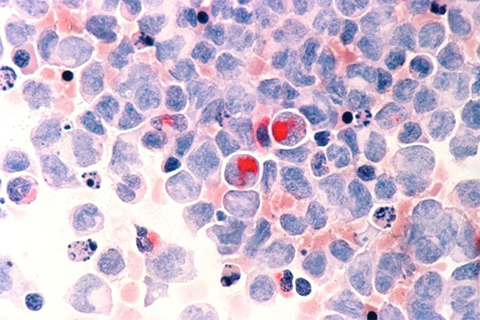 Acute myeloid leukemia cells.