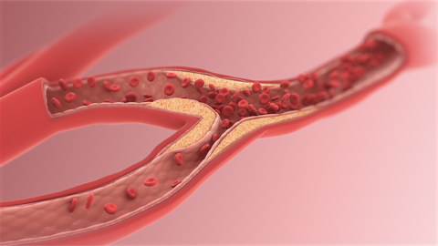 An arteriole with restricted blood flow is one possible result of high triglyceride levels.