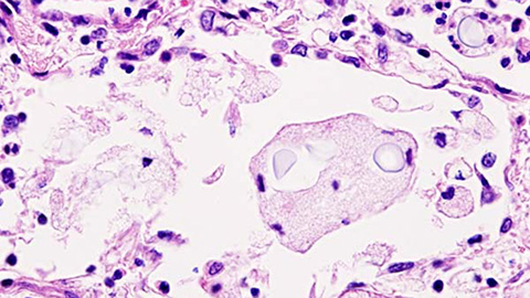 Blood proteomics reveals fungal infection signatures for faster diagnosis