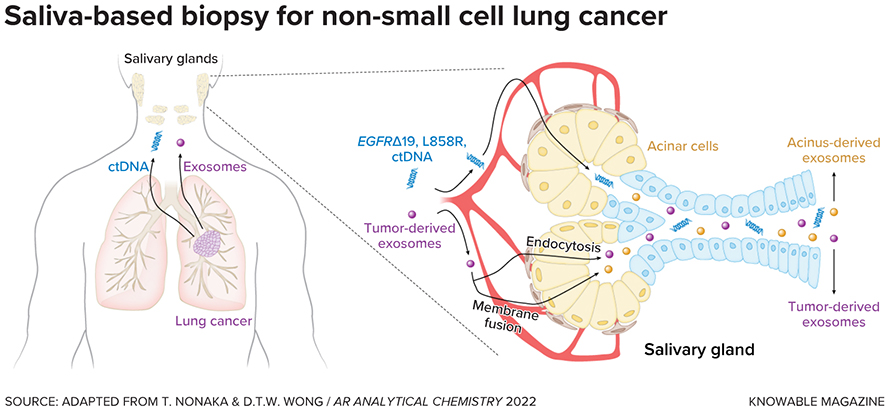 Scientists have found that saliva may contain biochemical signals (biomarkers) that provide an alert that a person has non-small cell lung cancer, the most common type of lung cancer. These signals are circulating tumor DNA (ctDNA) and tumor-derived exosomes that enter the circulation and reach the salivary glands. Both are taken up by secretory (acinar) cells of the salivary glands and are included in the saliva the glands produce. The presence of certain ctDNA mutations, combined with information provided by the exosomes, allow early detection and offer insight into the treatment of this type of cancer.