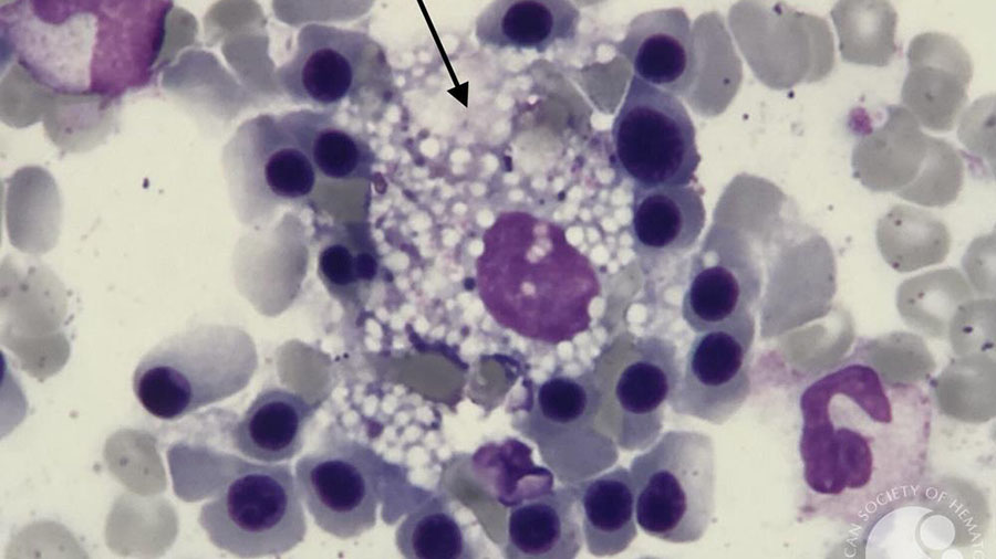 ApoA1 reduce atherosclerotic plaques via cell death pathway