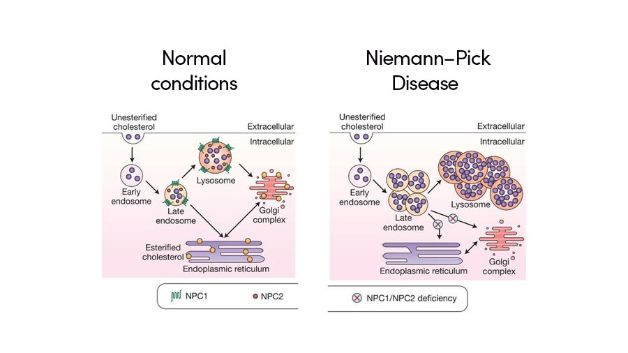 Niemann-Pick Disease - Types, Causes, Symptoms, Diagnosis & Treatment
