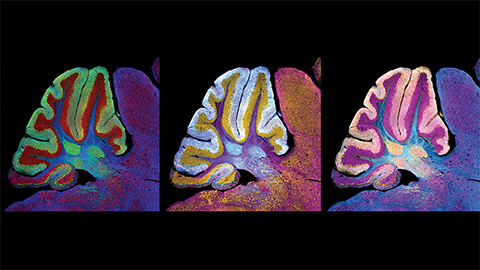 JLR: A close-up of the lipids in Niemann–Pick disease